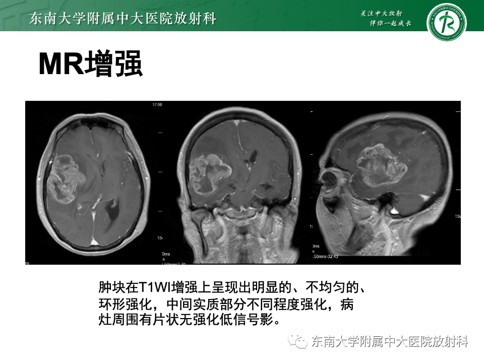 影像PPT - 【PPT】原发性中枢神经系统淋巴瘤-26 影像PPT - 【PPT】原发性中枢神经系统淋巴瘤-26