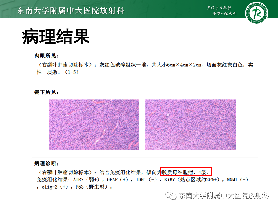 影像PPT - 【PPT】原发性中枢神经系统淋巴瘤-27 影像PPT - 【PPT】原发性中枢神经系统淋巴瘤-27