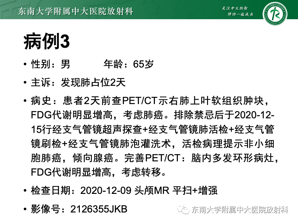 影像PPT - 【PPT】原发性中枢神经系统淋巴瘤-29 影像PPT - 【PPT】原发性中枢神经系统淋巴瘤-29
