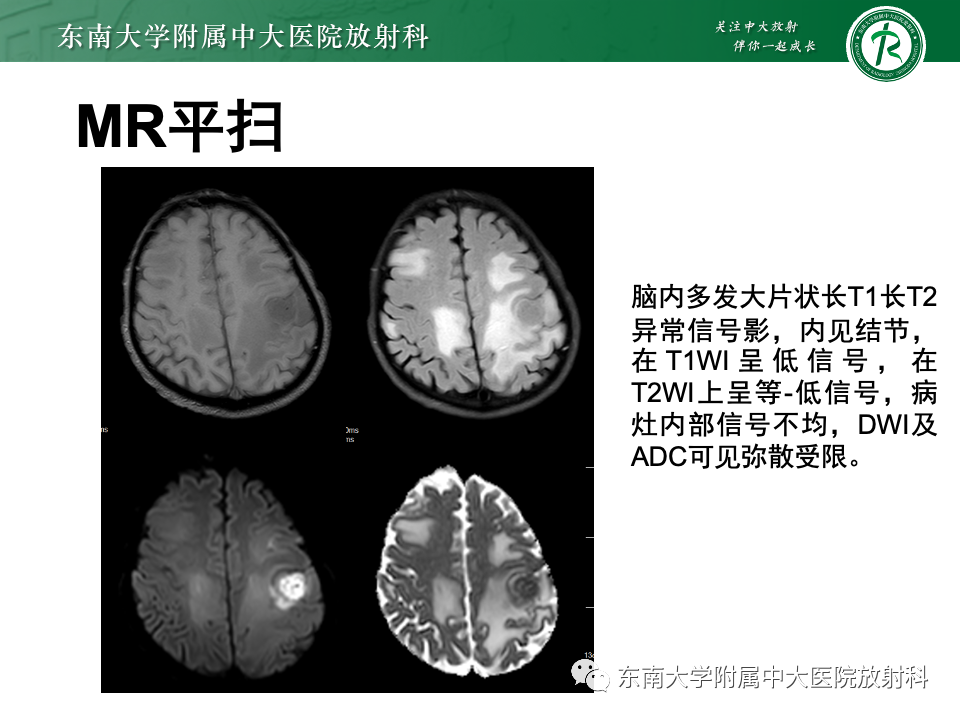 影像PPT - 【PPT】原发性中枢神经系统淋巴瘤-30 影像PPT - 【PPT】原发性中枢神经系统淋巴瘤-30