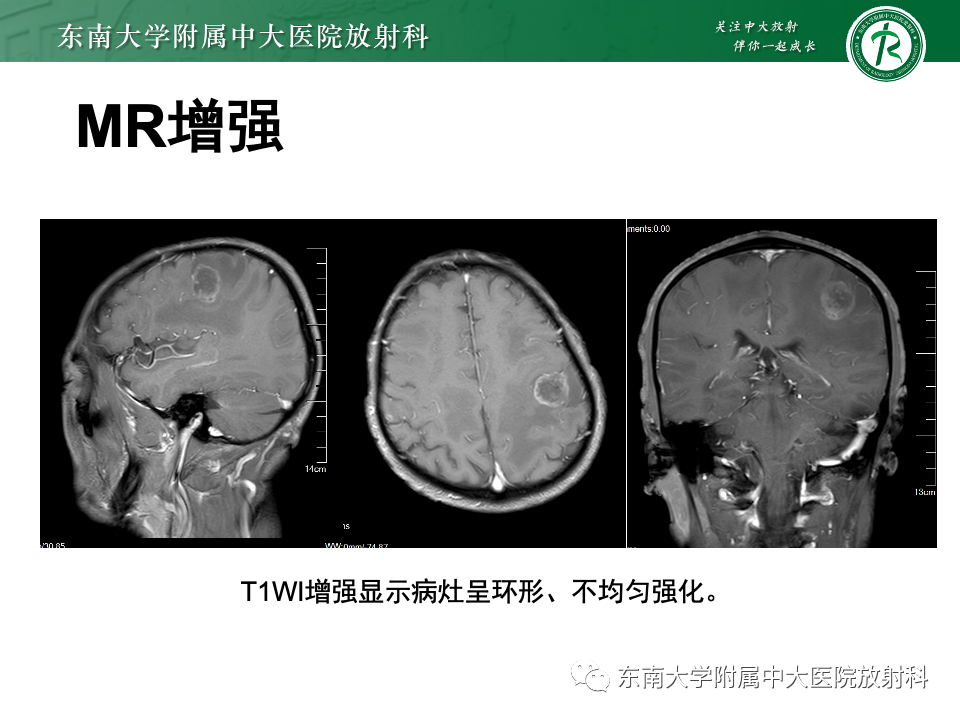 影像PPT - 【PPT】原发性中枢神经系统淋巴瘤-31 影像PPT - 【PPT】原发性中枢神经系统淋巴瘤-31