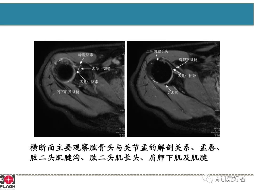 影像PPT - 【PPT】肩关节解剖与运动损伤影像诊断-8
