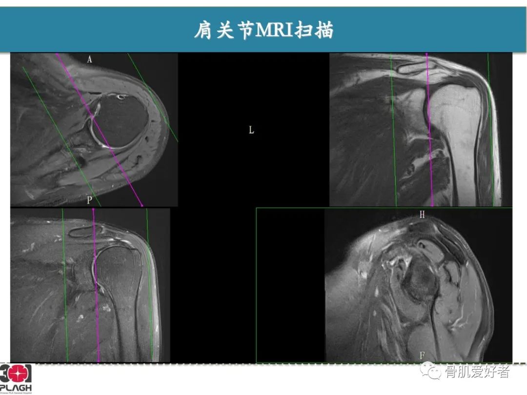 影像PPT - 【PPT】肩关节解剖与运动损伤影像诊断-7