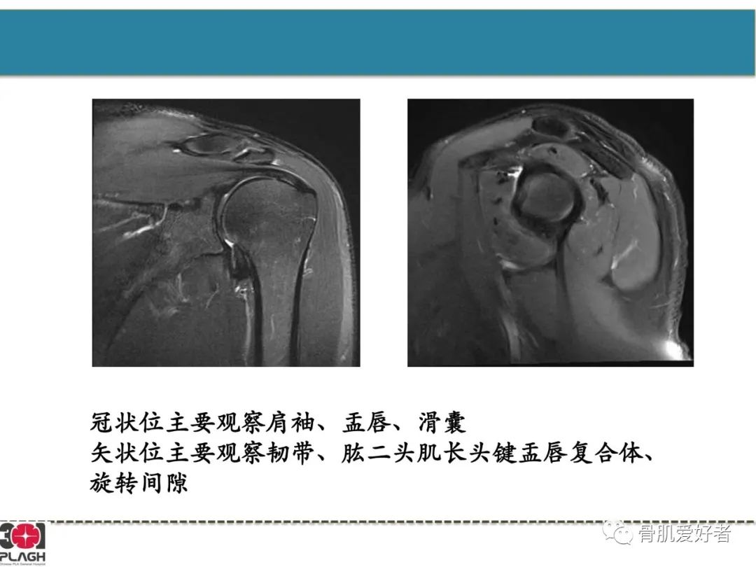 影像PPT - 【PPT】肩关节解剖与运动损伤影像诊断-10