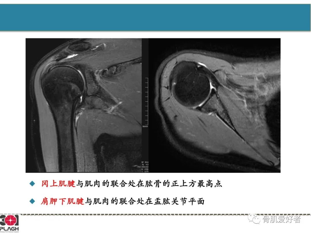 影像PPT - 【PPT】肩关节解剖与运动损伤影像诊断-14