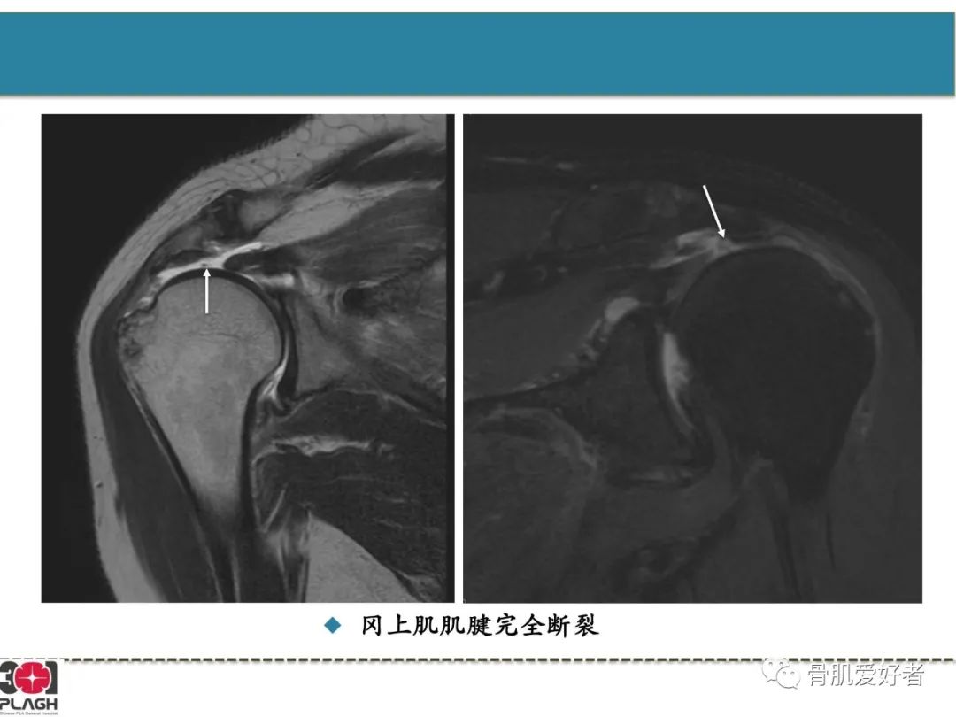 影像PPT - 【PPT】肩关节解剖与运动损伤影像诊断-19