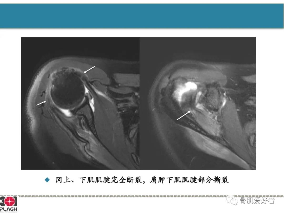 影像PPT - 【PPT】肩关节解剖与运动损伤影像诊断-20