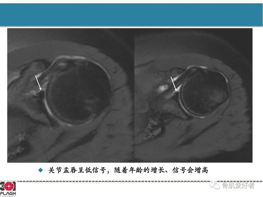 影像PPT - 【PPT】肩关节解剖与运动损伤影像诊断-26