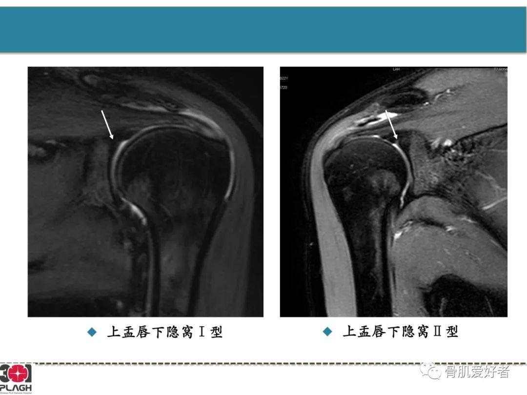 影像PPT - 【PPT】肩关节解剖与运动损伤影像诊断-29