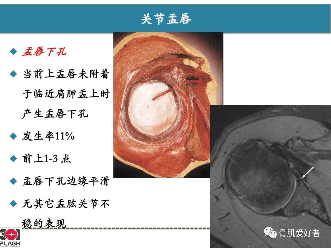 影像PPT - 【PPT】肩关节解剖与运动损伤影像诊断-31
