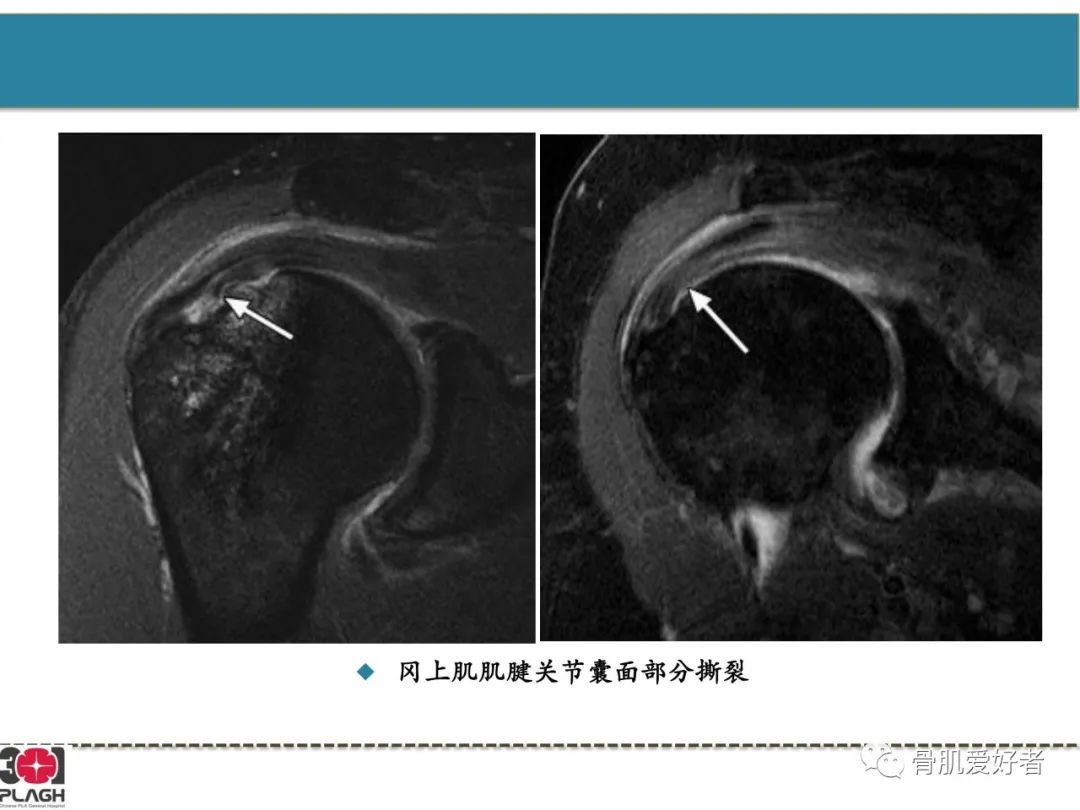 影像PPT - 【PPT】肩关节解剖与运动损伤影像诊断-18