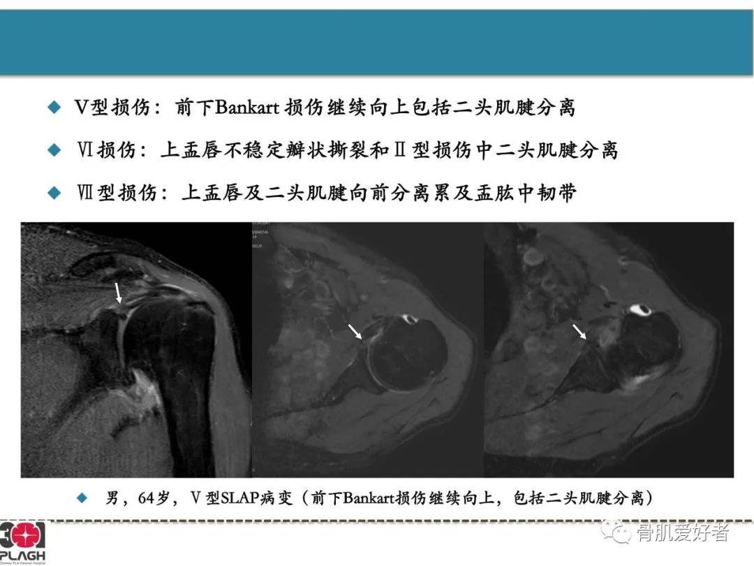 影像PPT - 【PPT】肩关节解剖与运动损伤影像诊断-40