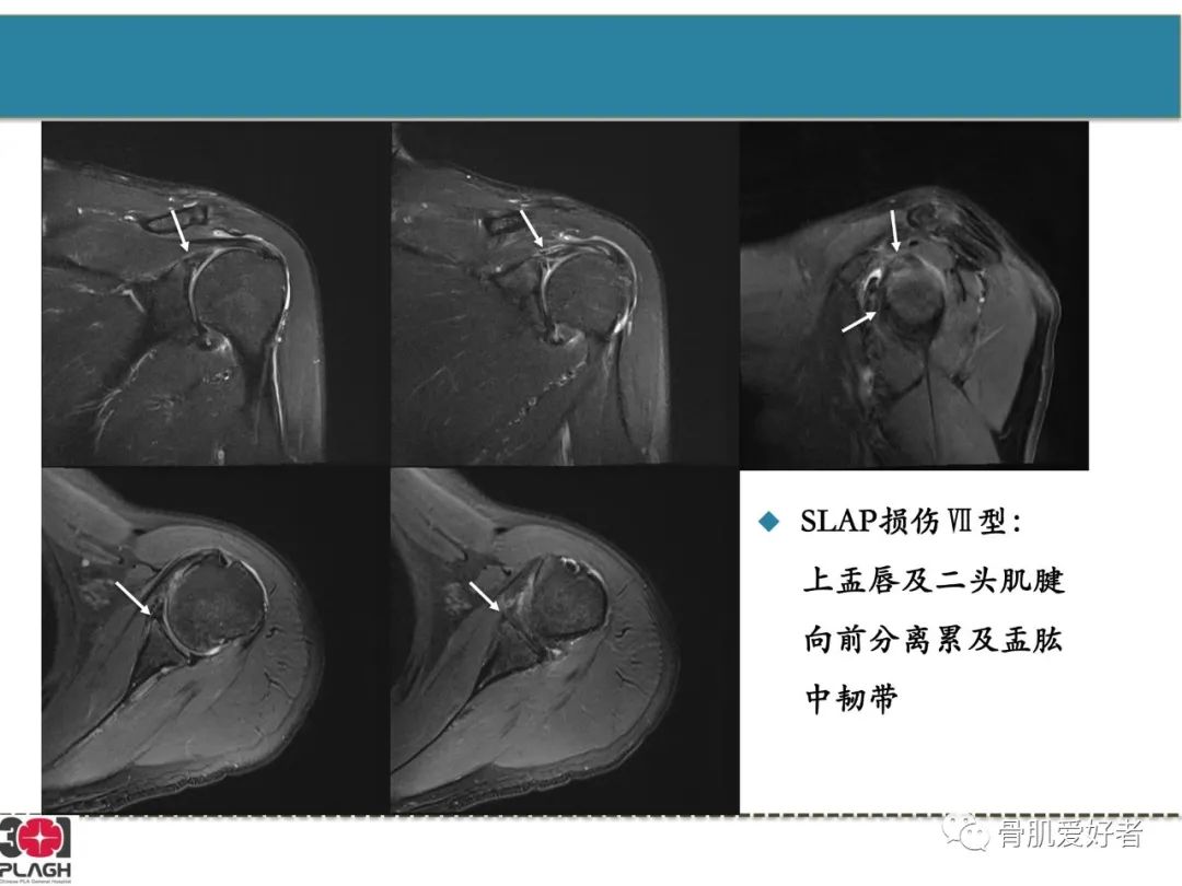 影像PPT - 【PPT】肩关节解剖与运动损伤影像诊断-41