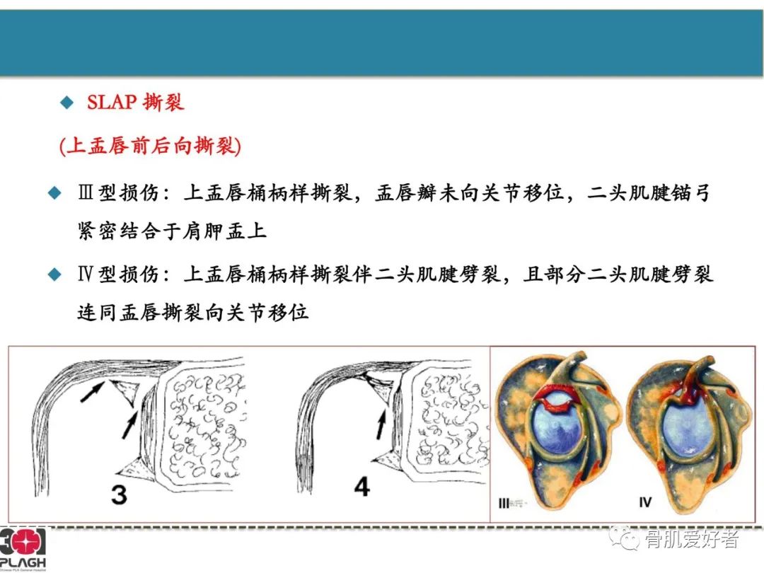 影像PPT - 【PPT】肩关节解剖与运动损伤影像诊断-39