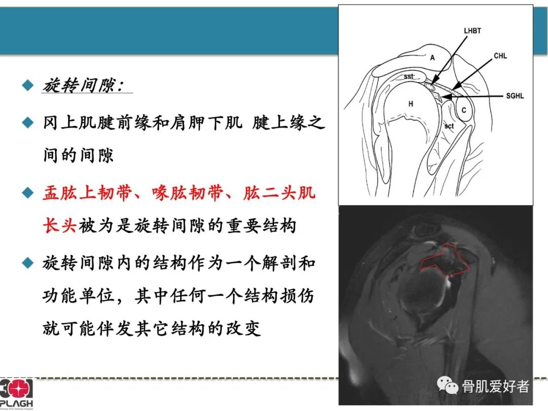 影像PPT - 【PPT】肩关节解剖与运动损伤影像诊断-48