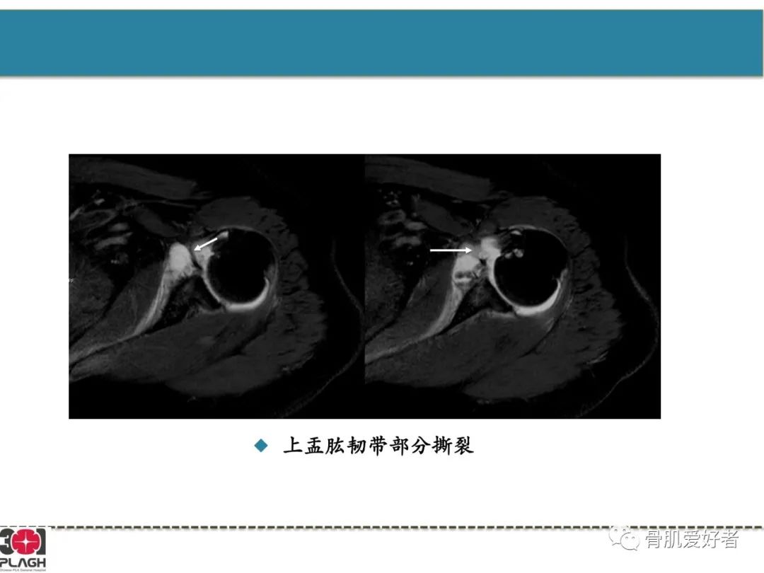 影像PPT - 【PPT】肩关节解剖与运动损伤影像诊断-49