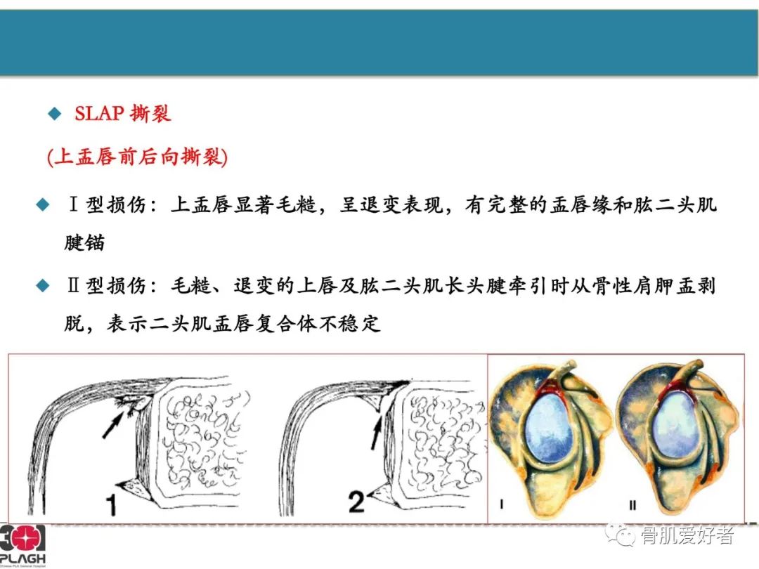影像PPT - 【PPT】肩关节解剖与运动损伤影像诊断-37