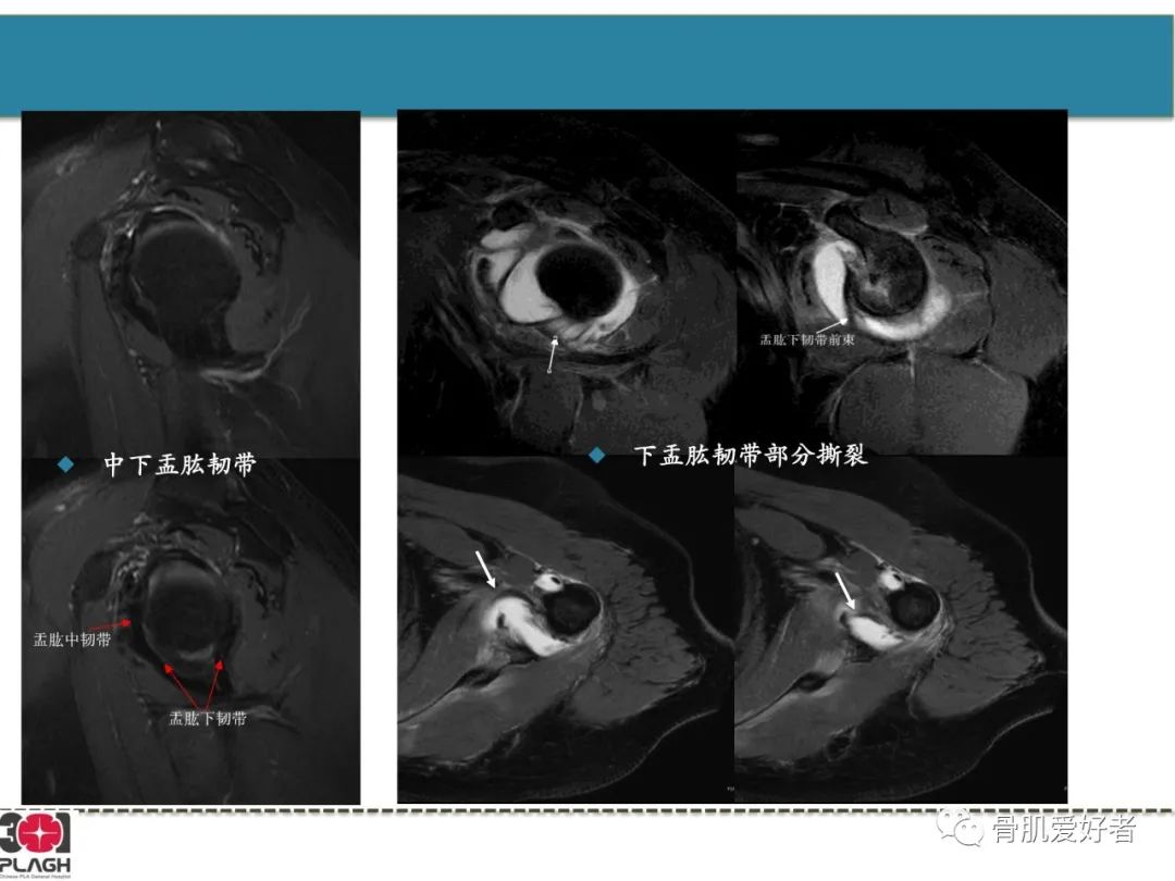 影像PPT - 【PPT】肩关节解剖与运动损伤影像诊断-54