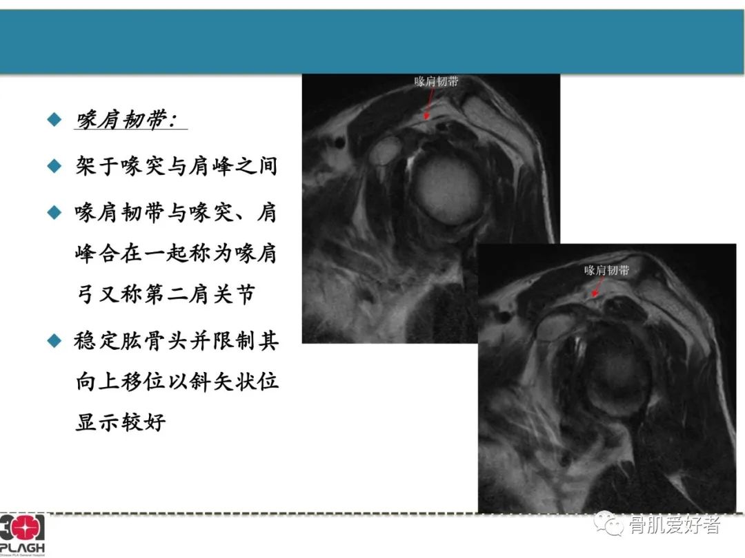 影像PPT - 【PPT】肩关节解剖与运动损伤影像诊断-56