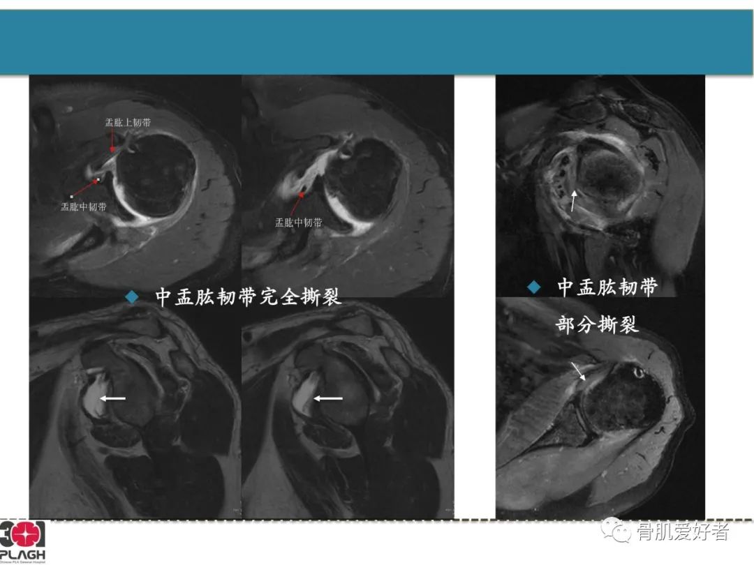 影像PPT - 【PPT】肩关节解剖与运动损伤影像诊断-52