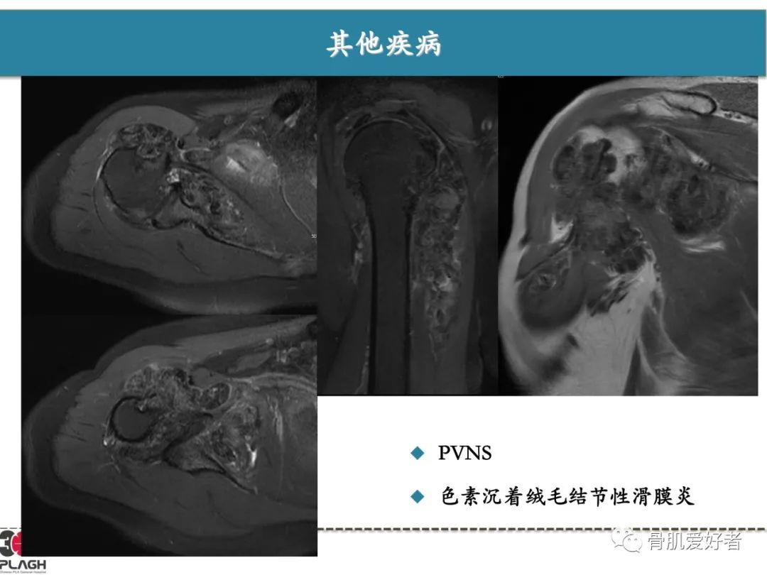 影像PPT - 【PPT】肩关节解剖与运动损伤影像诊断-63