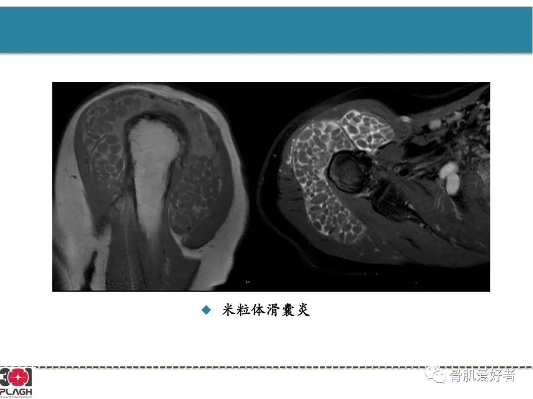 影像PPT - 【PPT】肩关节解剖与运动损伤影像诊断-64