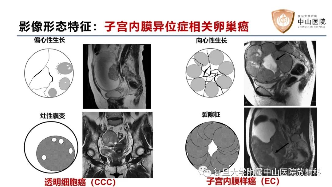 影像PPT - 【病例】卵巢4种上皮源性肿瘤影像鉴别-15