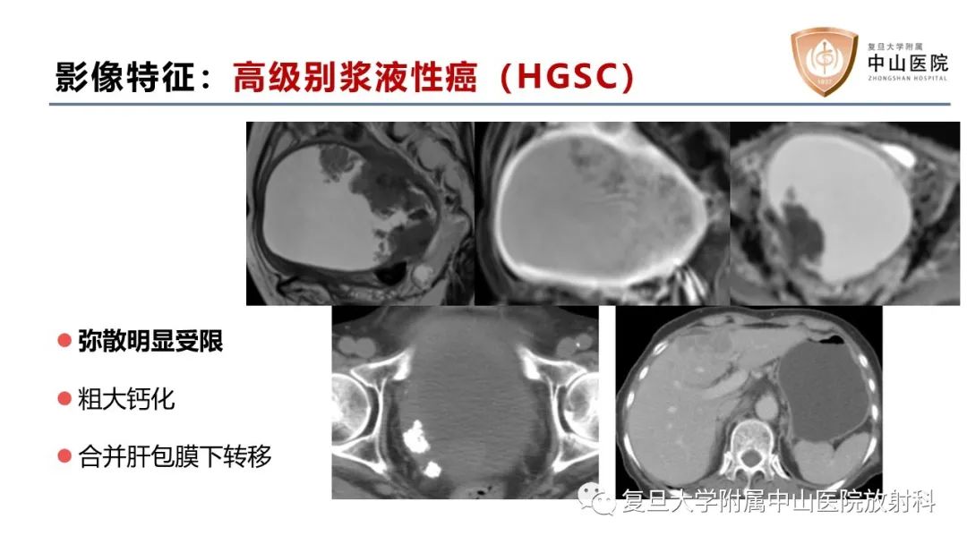 影像PPT - 【病例】卵巢4种上皮源性肿瘤影像鉴别-18
