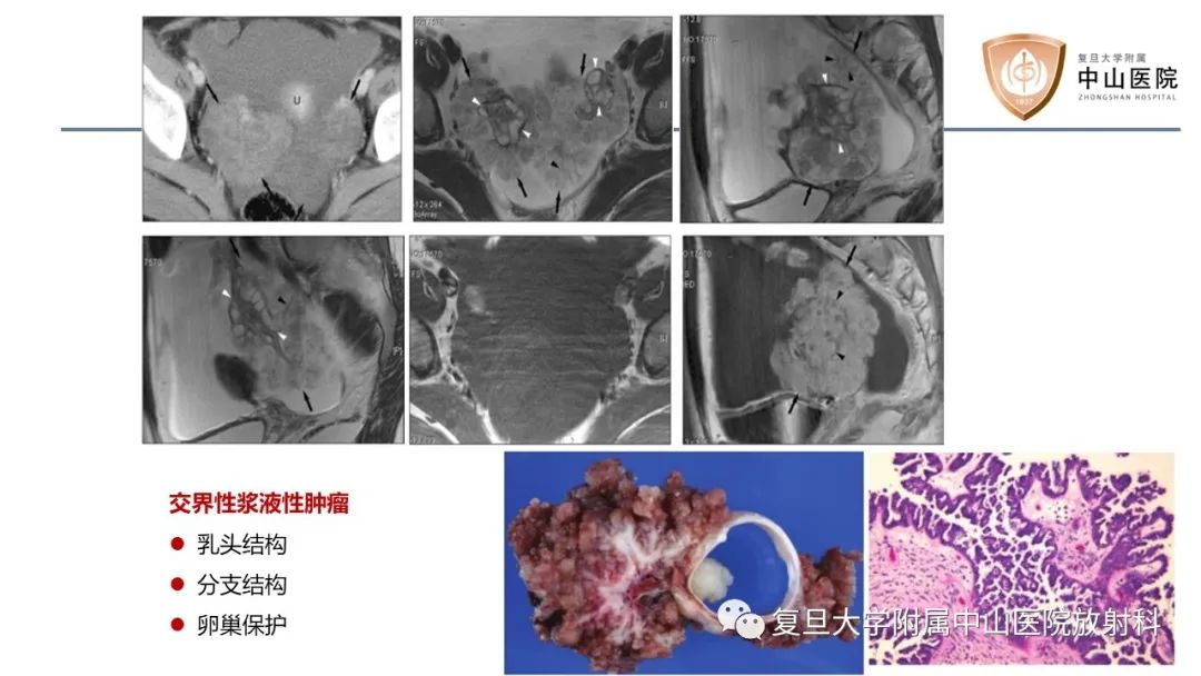 影像PPT - 【病例】卵巢4种上皮源性肿瘤影像鉴别-20