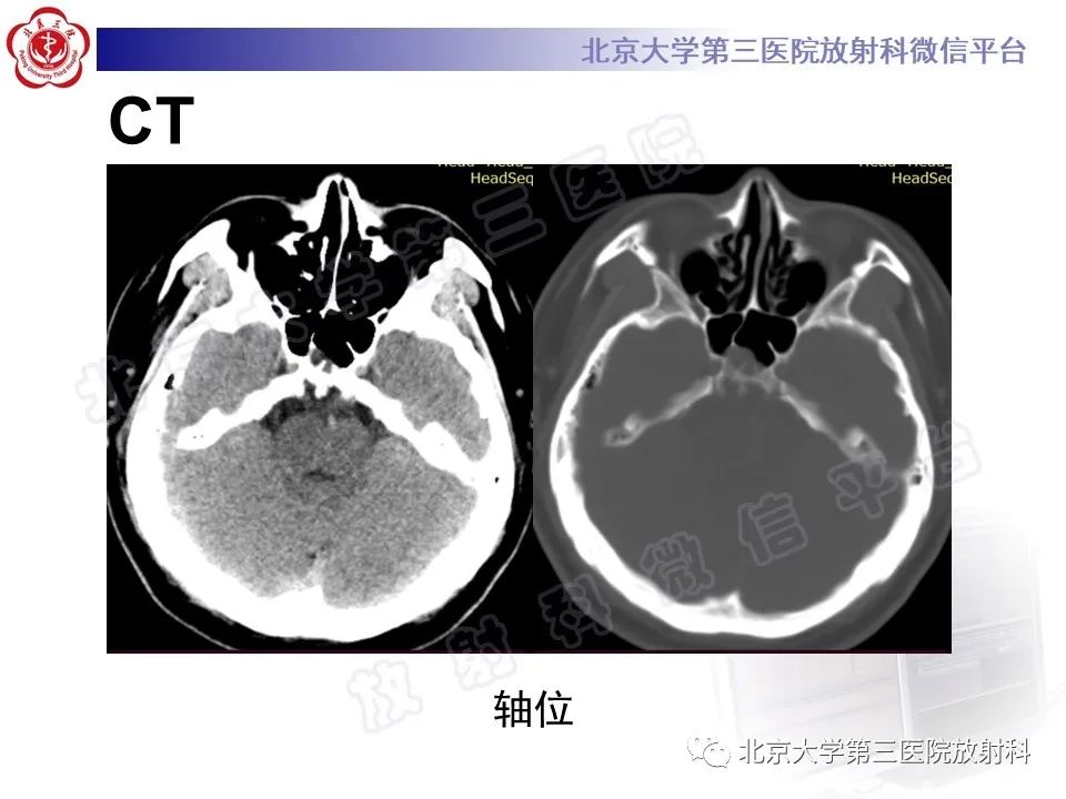 影像PPT - 【PPT】脊索瘤-3