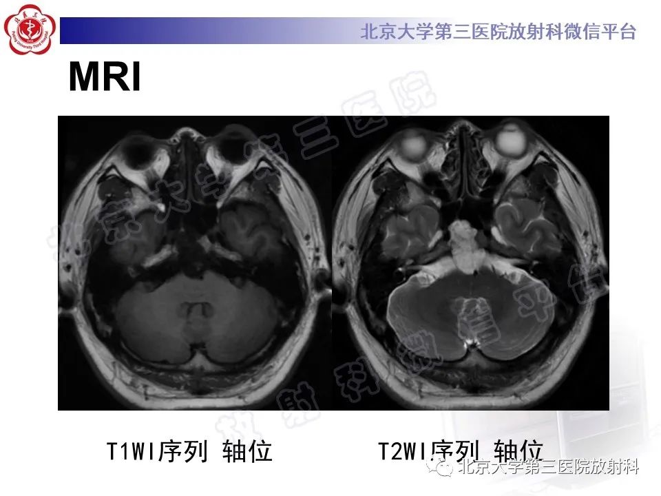 影像PPT - 【PPT】脊索瘤-4