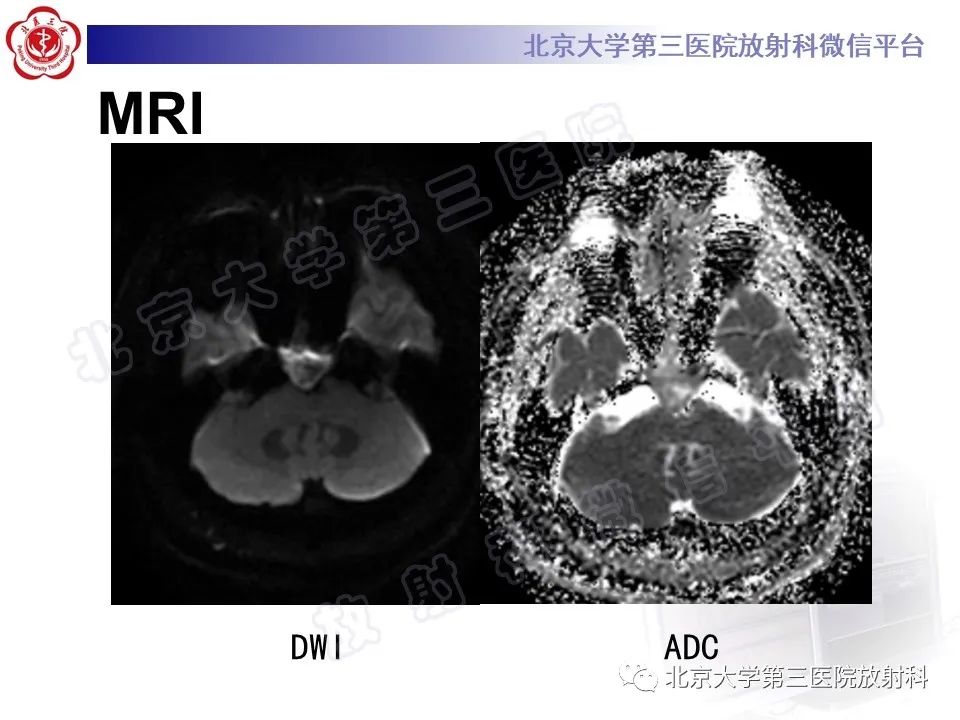 影像PPT - 【PPT】脊索瘤-6