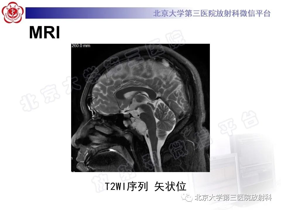 影像PPT - 【PPT】脊索瘤-5