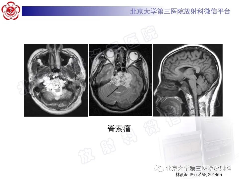 影像PPT - 【PPT】脊索瘤-15