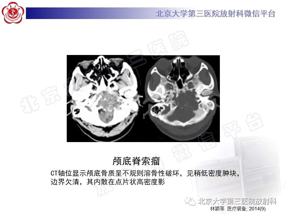 影像PPT - 【PPT】脊索瘤-17