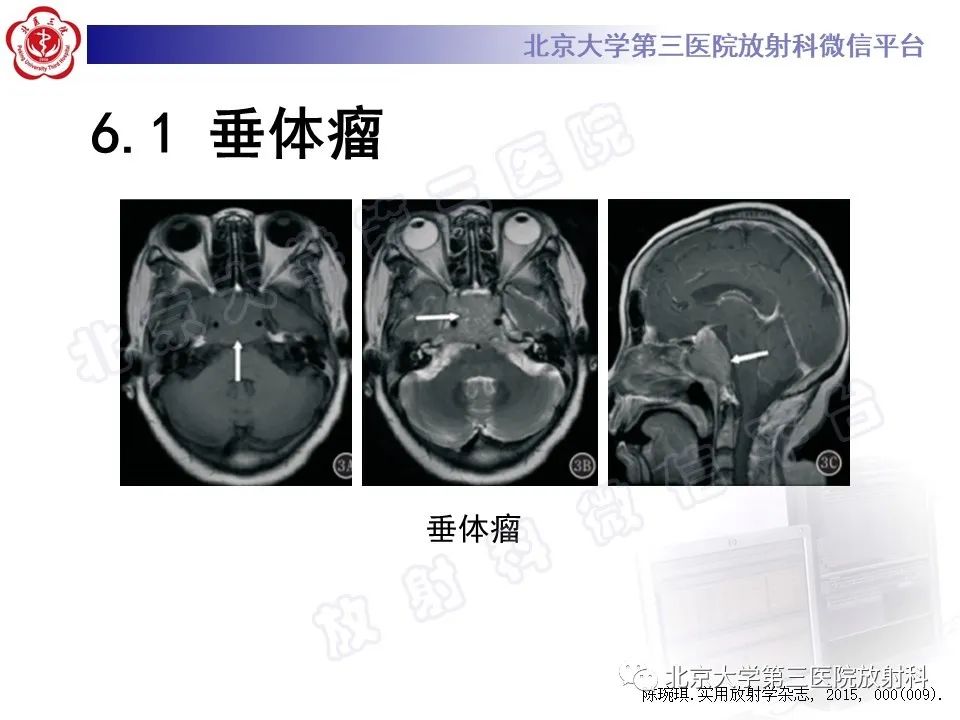 影像PPT - 【PPT】脊索瘤-20