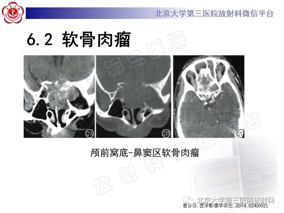 影像PPT - 【PPT】脊索瘤-23
