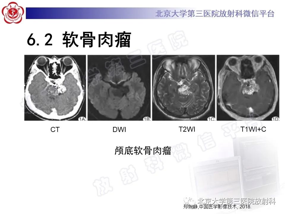 影像PPT - 【PPT】脊索瘤-24