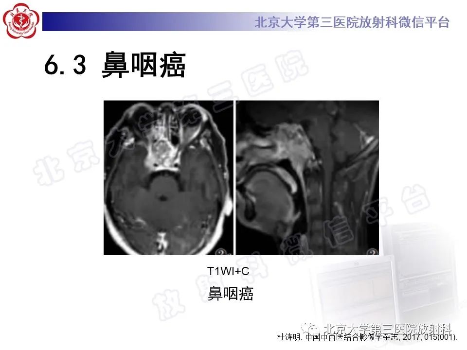 影像PPT - 【PPT】脊索瘤-27