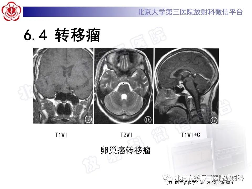 影像PPT - 【PPT】脊索瘤-29
