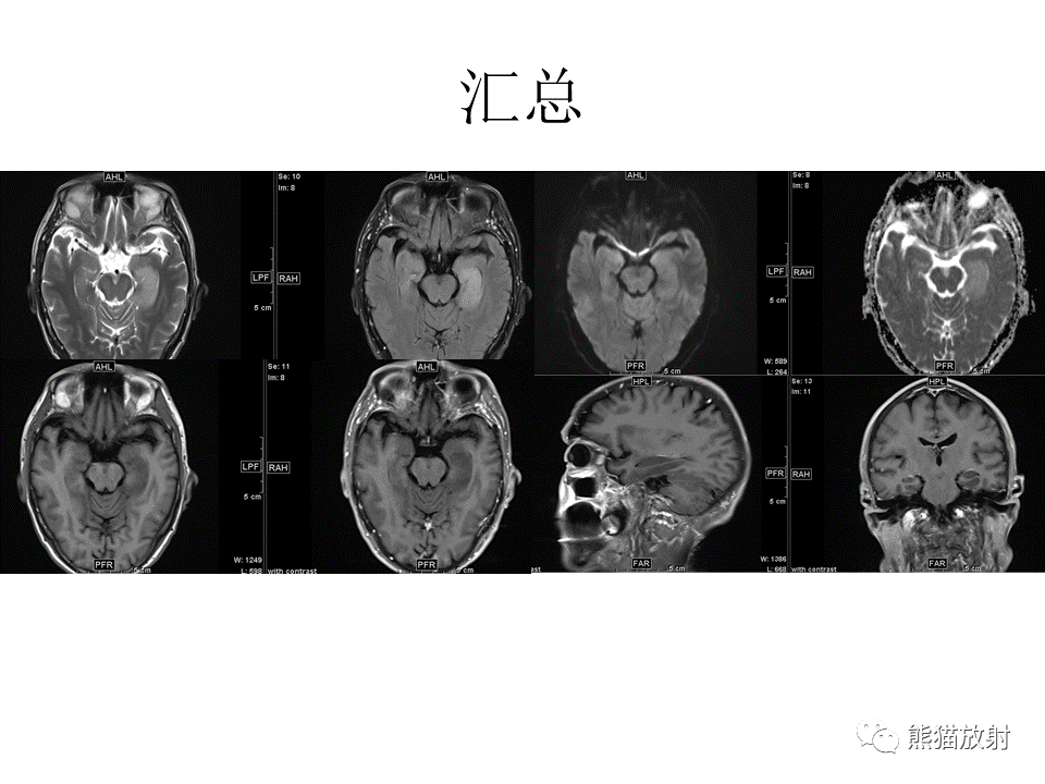 影像PPT - 【PPT】颅内节细胞胶质瘤2例MR影像-22