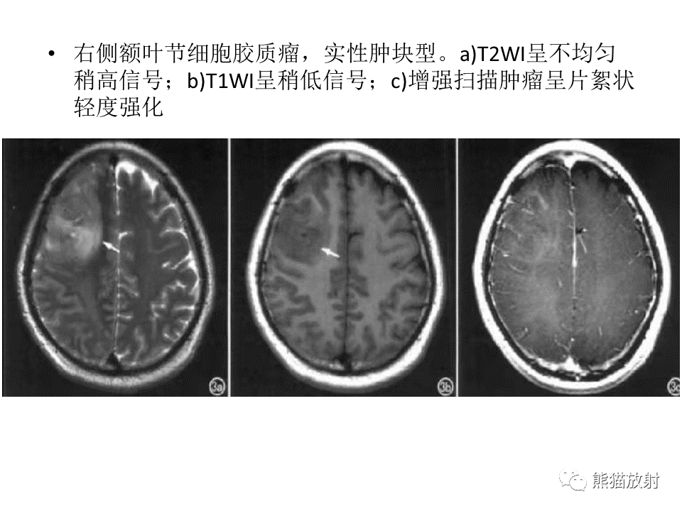影像PPT - 【PPT】颅内节细胞胶质瘤2例MR影像-28