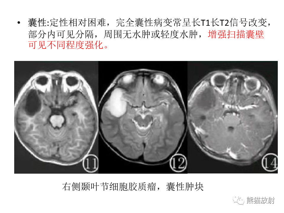 影像PPT - 【PPT】颅内节细胞胶质瘤2例MR影像-31