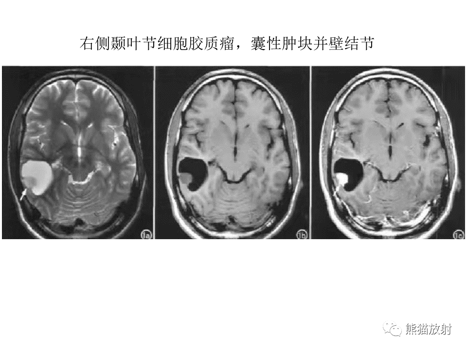 影像PPT - 【PPT】颅内节细胞胶质瘤2例MR影像-30
