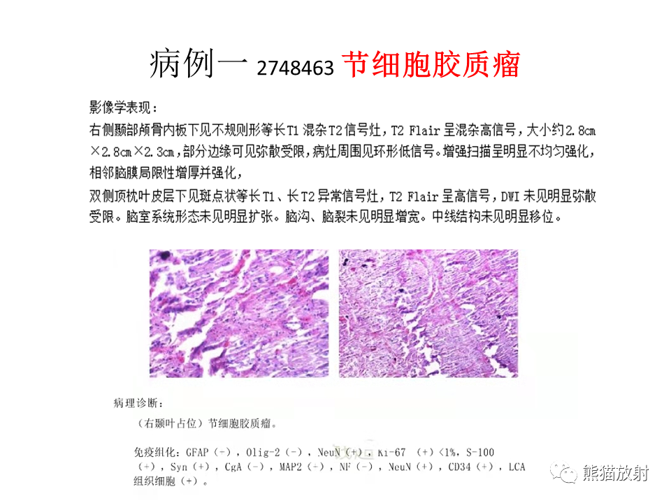 影像PPT - 【PPT】颅内节细胞胶质瘤2例MR影像-24