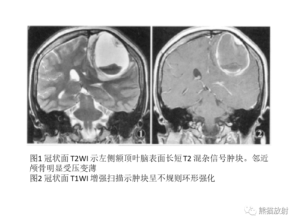 影像PPT - 【PPT】颅内节细胞胶质瘤2例MR影像-37