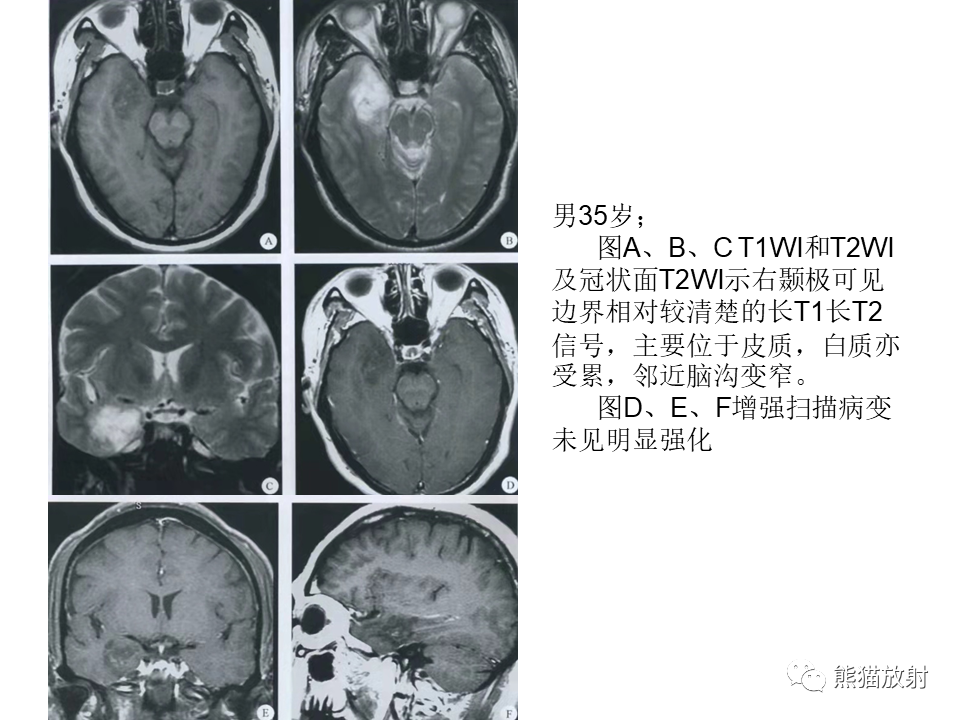影像PPT - 【PPT】颅内节细胞胶质瘤2例MR影像-41