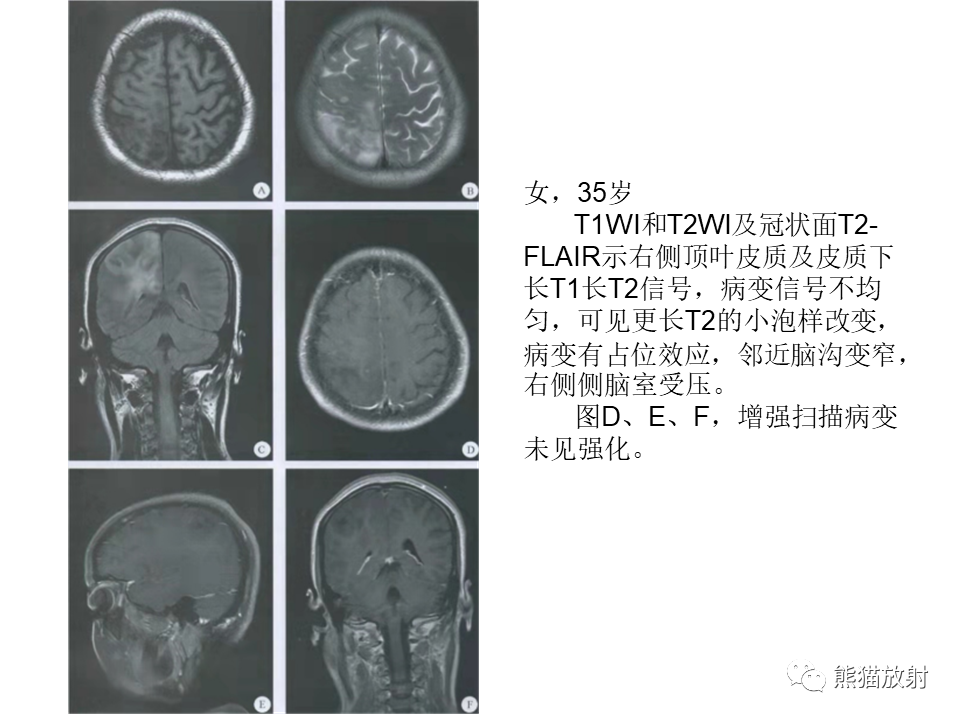 影像PPT - 【PPT】颅内节细胞胶质瘤2例MR影像-40