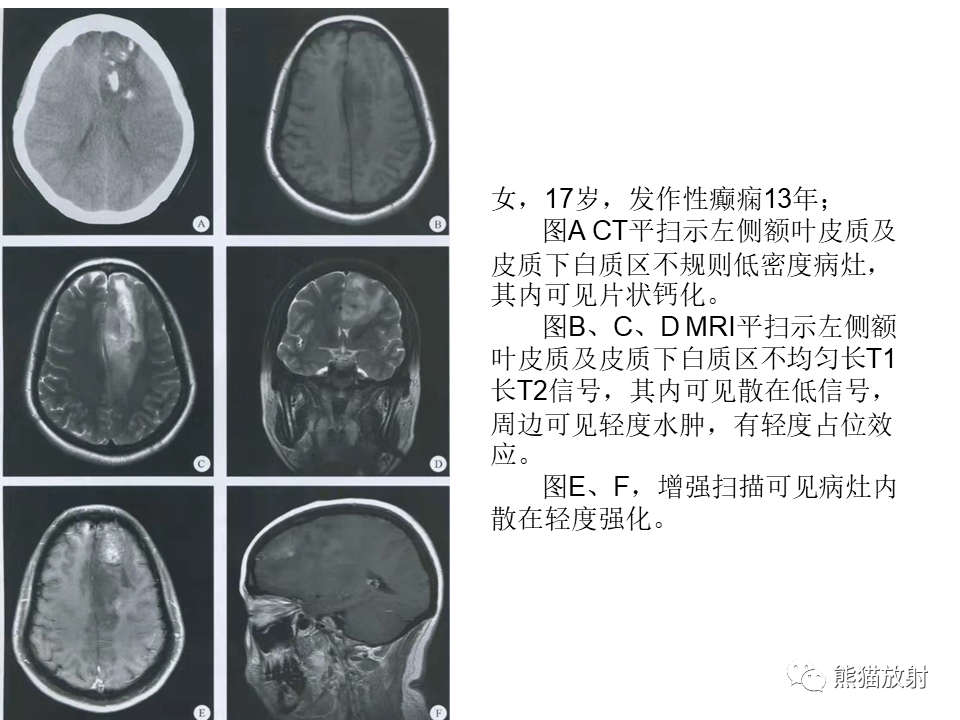 影像PPT - 【PPT】颅内节细胞胶质瘤2例MR影像-35
