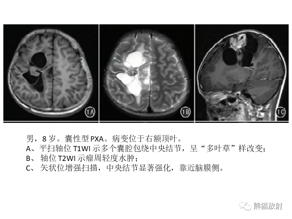 影像PPT - 【PPT】颅内节细胞胶质瘤2例MR影像-44